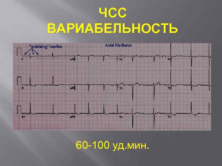 ЧСС ВАРИАБЕЛЬНОСТЬ 150 60 уд. мин. 60 100 уд. мин. 