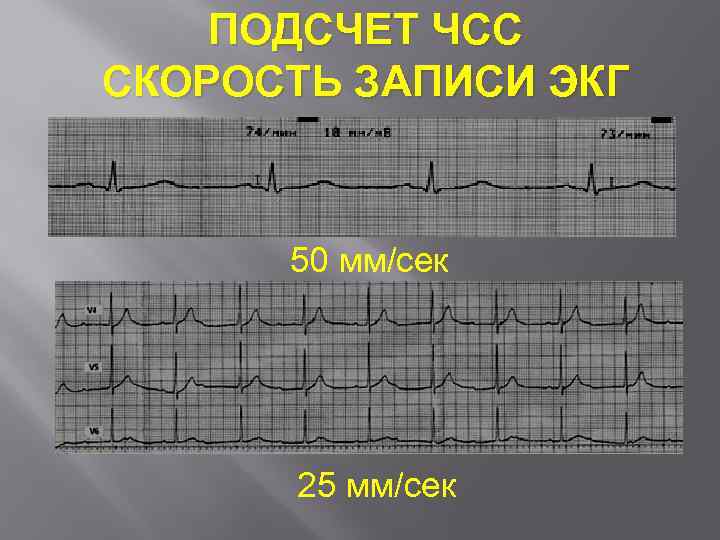 ПОДСЧЕТ ЧСС СКОРОСТЬ ЗАПИСИ ЭКГ 50 мм/сек 25 мм/сек 