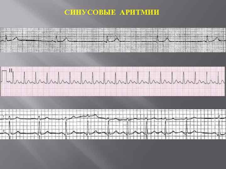 СИНУСОВЫЕ АРИТМИИ 