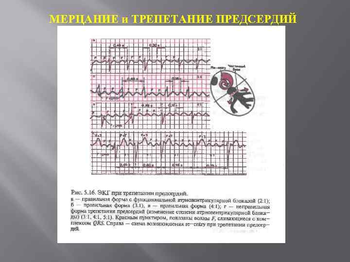 МЕРЦАНИЕ и ТРЕПЕТАНИЕ ПРЕДСЕРДИЙ 