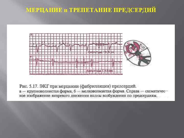 МЕРЦАНИЕ и ТРЕПЕТАНИЕ ПРЕДСЕРДИЙ 