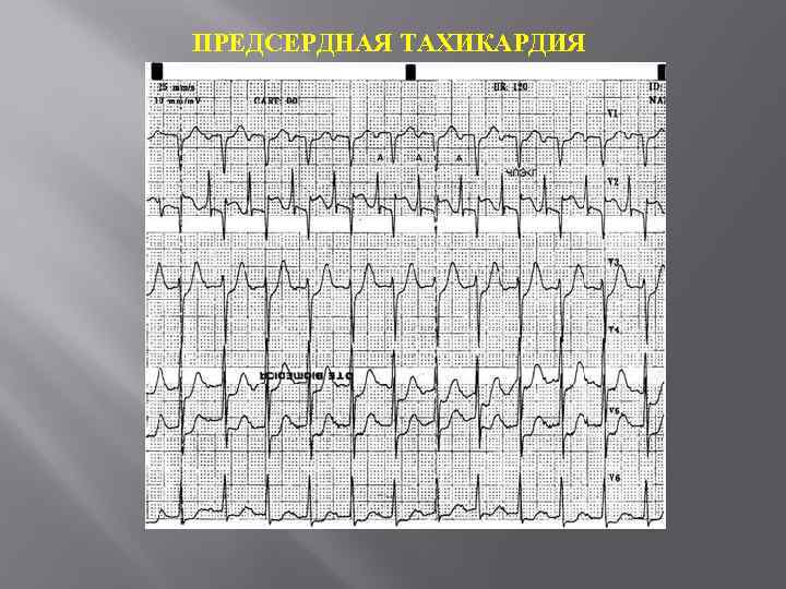 ПРЕДСЕРДНАЯ ТАХИКАРДИЯ 