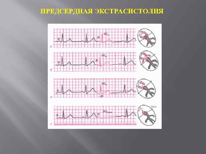 ПРЕДСЕРДНАЯ ЭКСТРАСИСТОЛИЯ 