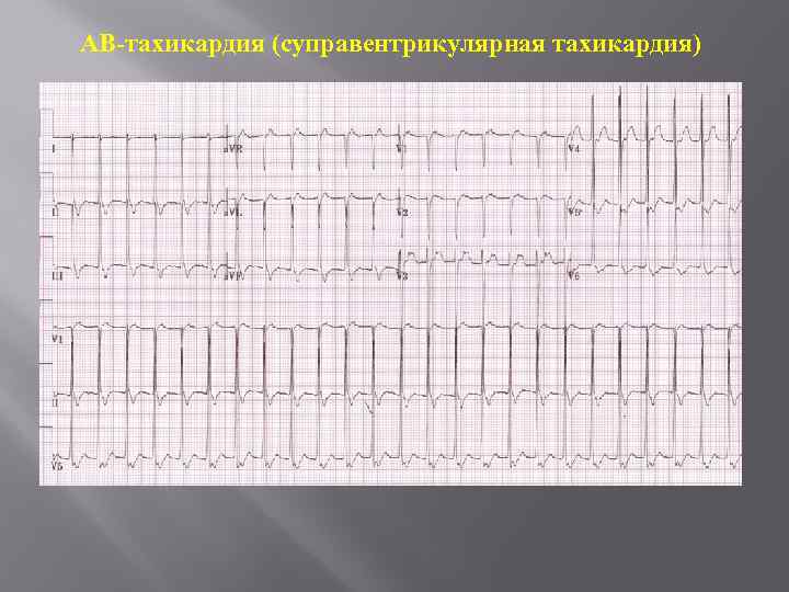 АВ-тахикардия (суправентрикулярная тахикардия) 