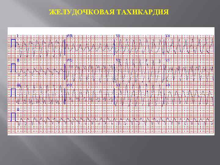 ЖЕЛУДОЧКОВАЯ ТАХИКАРДИЯ 