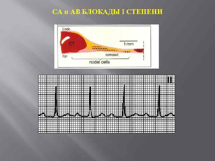 СА и АВ БЛОКАДЫ I СТЕПЕНИ 