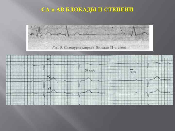 СА и АВ БЛОКАДЫ II СТЕПЕНИ 