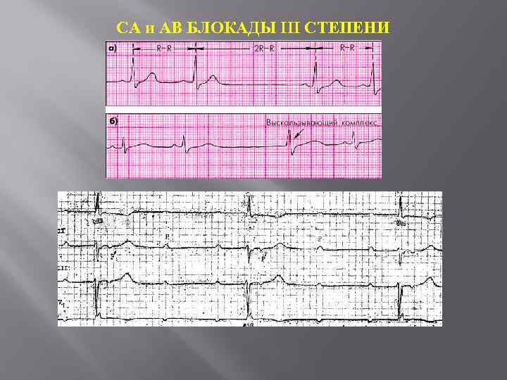 СА и АВ БЛОКАДЫ III СТЕПЕНИ 