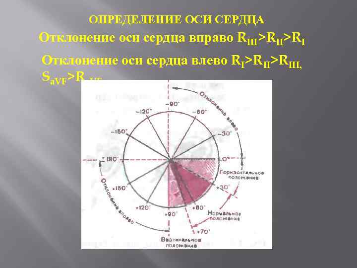 ОПРЕДЕЛЕНИЕ ОСИ СЕРДЦА Отклонение оси сердца вправо RIII>RI Отклонение оси сердца влево RI>RIII, Sa.