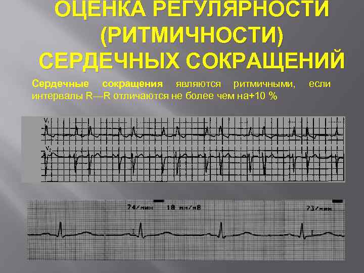 ОЦЕНКА РЕГУЛЯРНОСТИ (РИТМИЧНОСТИ) СЕРДЕЧНЫХ СОКРАЩЕНИЙ Сердечные сокращения являются ритмичными, интервалы R—R отличаются не более