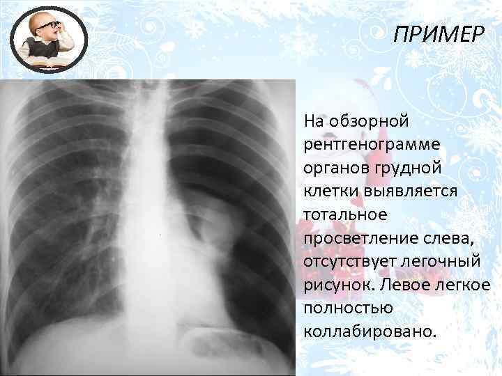 ПРИМЕР На обзорной рентгенограмме органов грудной клетки выявляется тотальное просветление слева, отсутствует легочный рисунок.