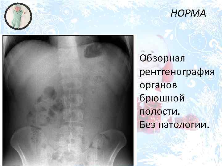 НОРМА Обзорная рентгенография органов брюшной полости. Без патологии. 