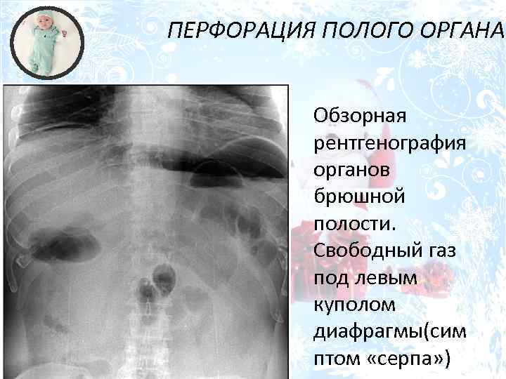 ПЕРФОРАЦИЯ ПОЛОГО ОРГАНА Обзорная рентгенография органов брюшной полости. Свободный газ под левым куполом диафрагмы(сим