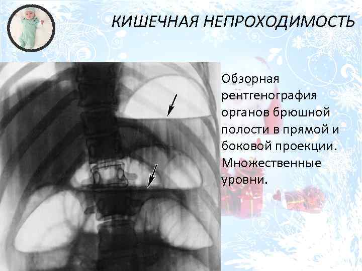 КИШЕЧНАЯ НЕПРОХОДИМОСТЬ Обзорная рентгенография органов брюшной полости в прямой и боковой проекции. Множественные уровни.