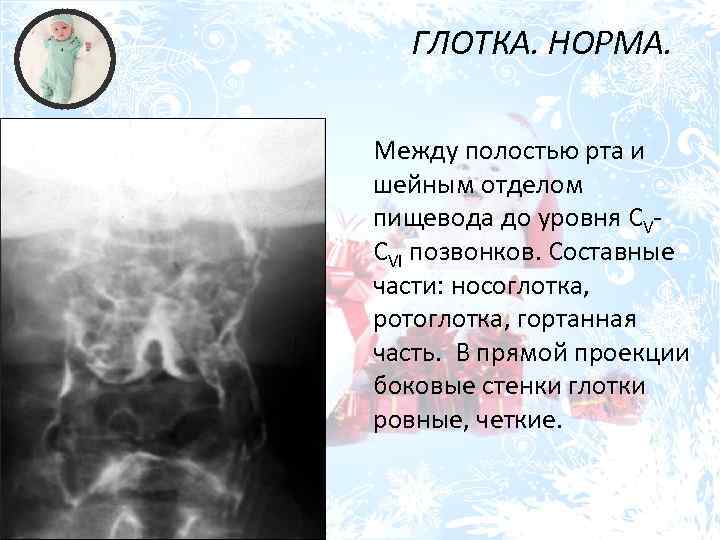 ГЛОТКА. НОРМА. Между полостью рта и шейным отделом пищевода до уровня CVCVI позвонков. Составные