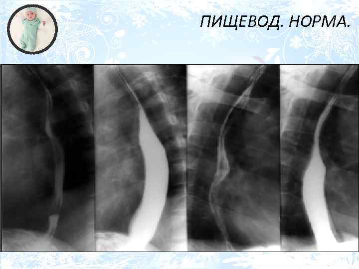 ПИЩЕВОД. НОРМА. 