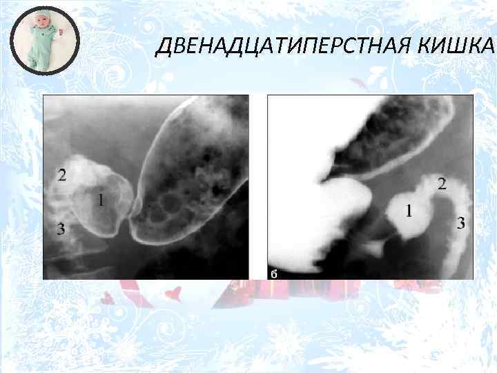 ДВЕНАДЦАТИПЕРСТНАЯ КИШКА 