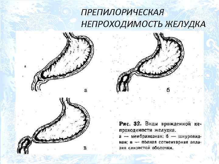 ПРЕПИЛОРИЧЕСКАЯ НЕПРОХОДИМОСТЬ ЖЕЛУДКА 