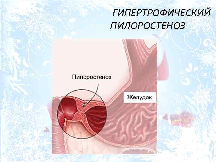  ГИПЕРТРОФИЧЕСКИЙ ПИЛОРОСТЕНОЗ 