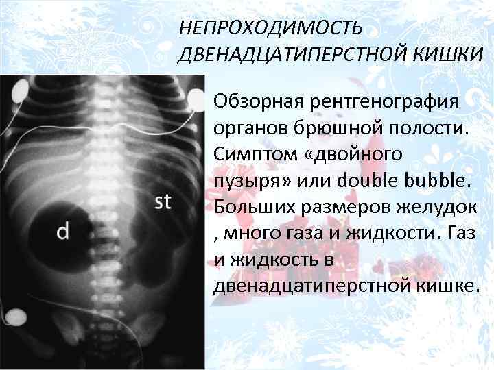 НЕПРОХОДИМОСТЬ ДВЕНАДЦАТИПЕРСТНОЙ КИШКИ Обзорная рентгенография органов брюшной полости. Симптом «двойного пузыря» или double bubble.