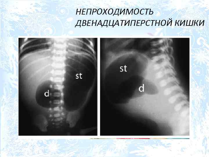 НЕПРОХОДИМОСТЬ ДВЕНАДЦАТИПЕРСТНОЙ КИШКИ 