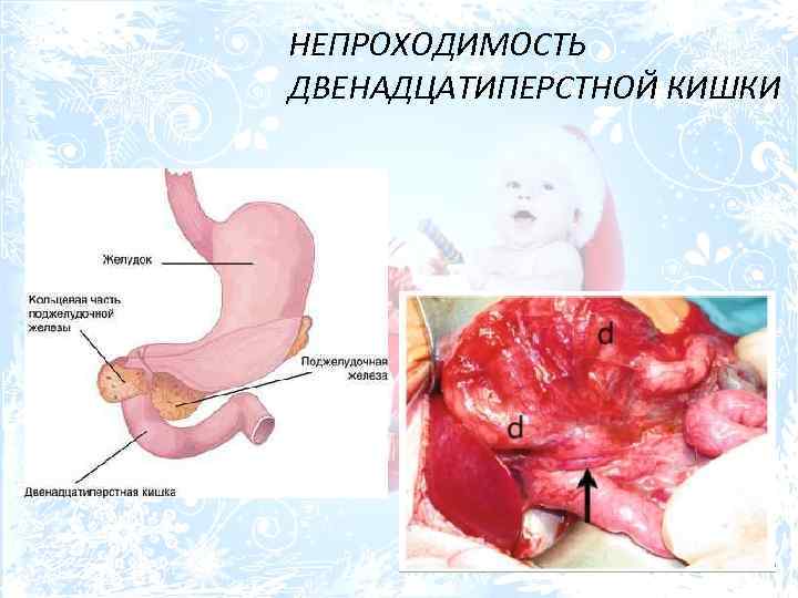 НЕПРОХОДИМОСТЬ ДВЕНАДЦАТИПЕРСТНОЙ КИШКИ 