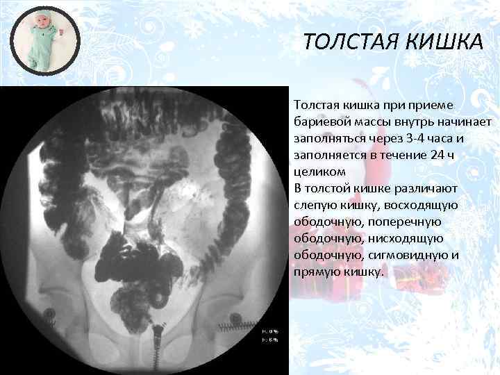 ТОЛСТАЯ КИШКА Толстая кишка приеме бариевой массы внутрь начинает заполняться через 3 -4 часа