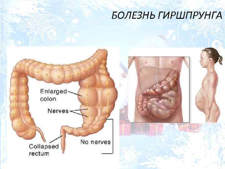 БОЛЕЗНЬ ГИРШПРУНГА 