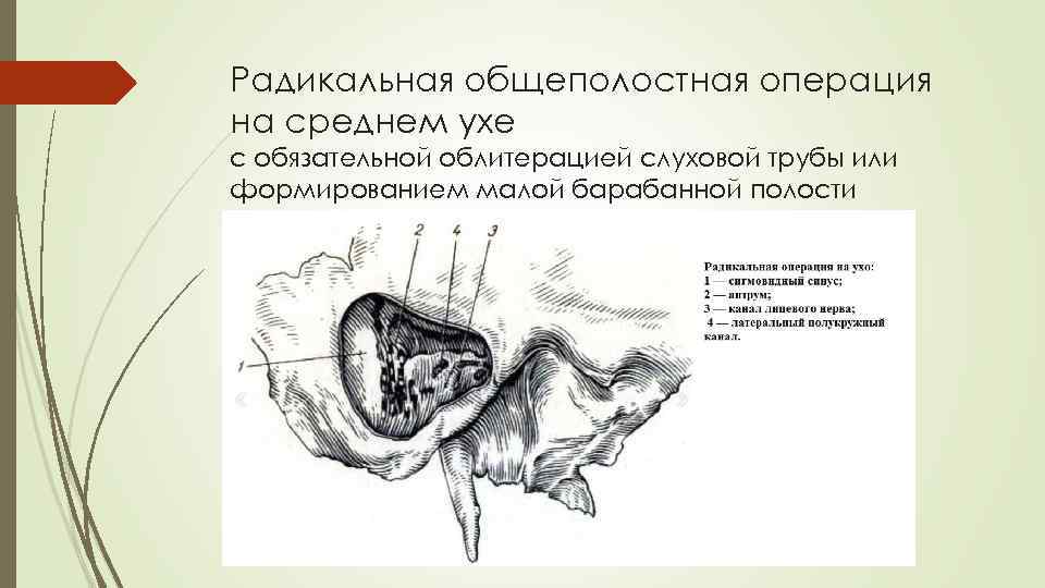 Радикальная общеполостная операция на среднем ухе с обязательной облитерацией слуховой трубы или формированием малой