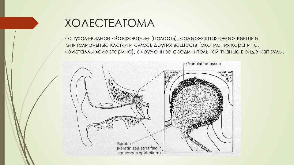 ХОЛЕСТЕАТОМА - опухолевидное образование (полость), содержащая омертвевшие эпителиальные клетки и смесь других веществ (скопления