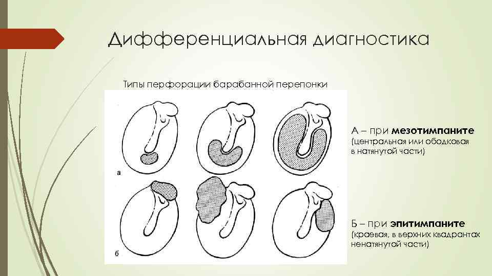 Дифференциальная диагностика Типы перфорации барабанной перепонки А – при мезотимпаните (центральная или ободковая в