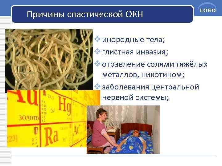 Причины спастической ОКН LOGO v инородные тела; v глистная инвазия; v отравление солями тяжёлых