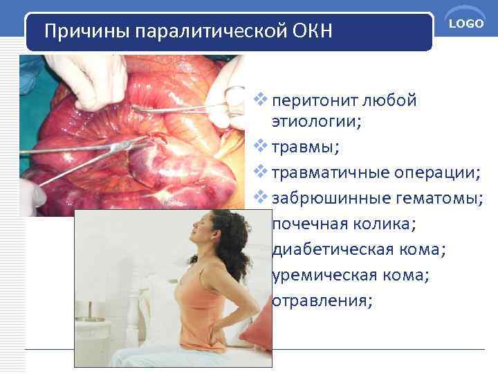 Причины паралитической ОКН LOGO v перитонит любой этиологии; v травмы; v травматичные операции; v
