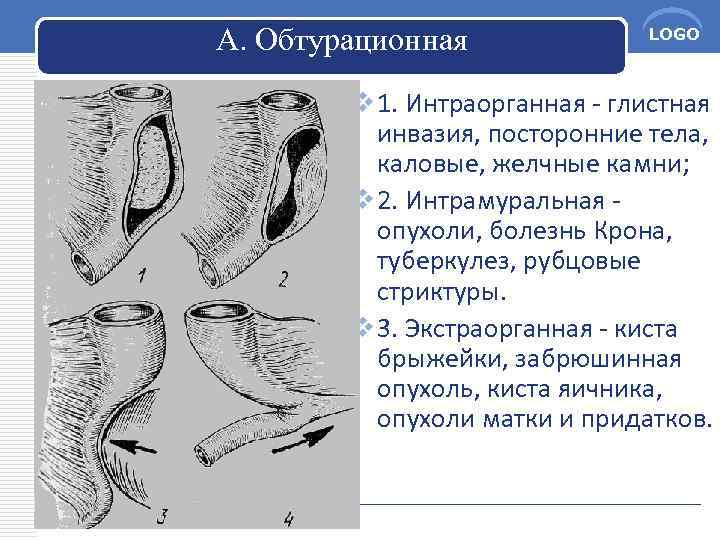 Обтурационная форма рака. Обтурационная форма. Обтурационная непроходимость. Обтурационная кишечная непроходимость. Интраорганная кишечная непроходимость.