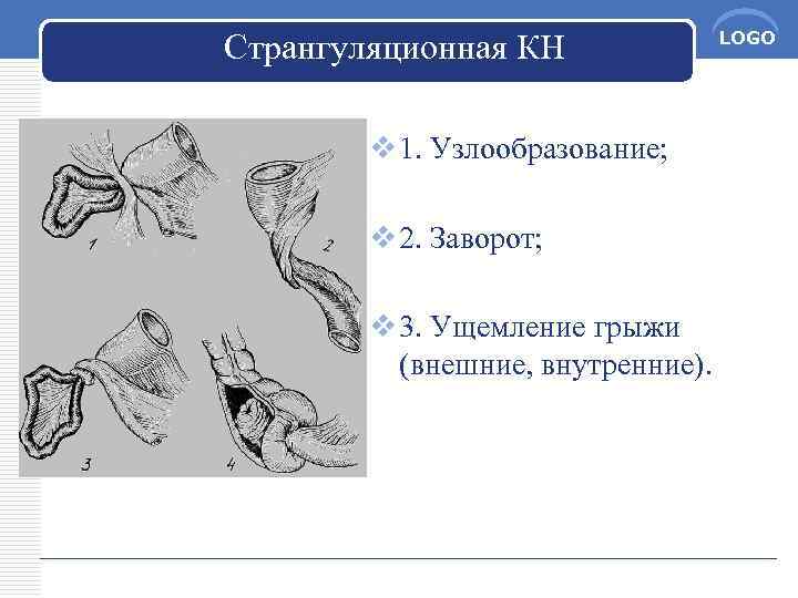 Странгуляционная КН v 1. Узлообразование; v 2. Заворот; v 3. Ущемление грыжи (внешние, внутренние).