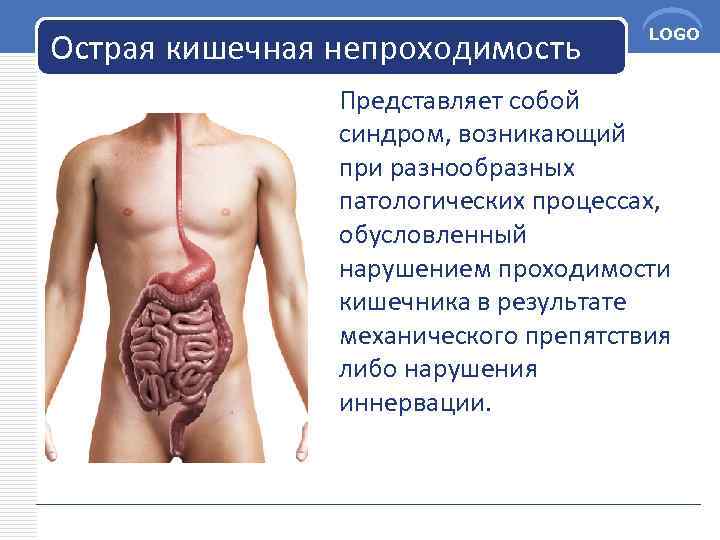 Острая кишечная непроходимость LOGO Представляет собой синдром, возникающий при разнообразных патологических процессах, обусловленный нарушением