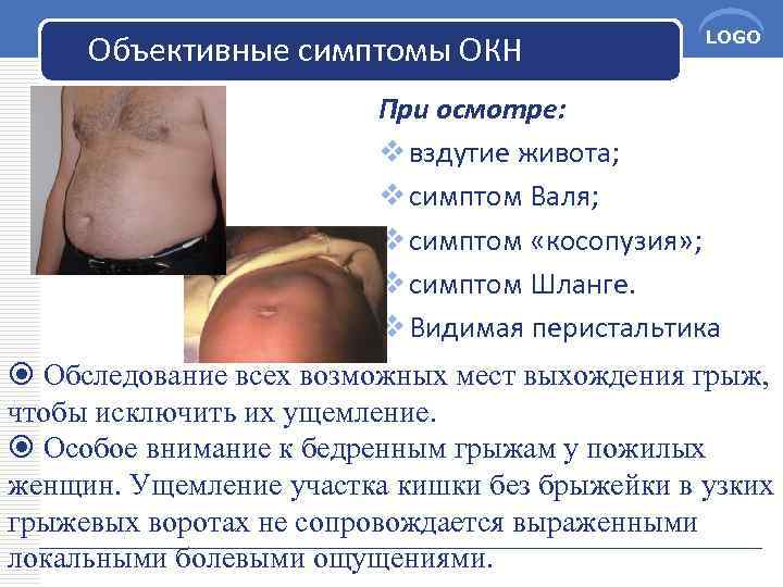 Объективные симптомы ОКН LOGO При осмотре: v вздутие живота; v симптом Валя; v симптом