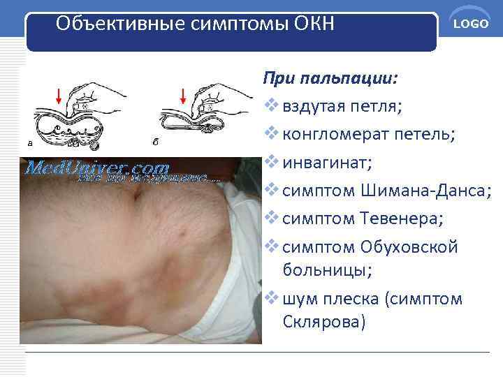 Объективные симптомы ОКН LOGO При пальпации: v вздутая петля; v конгломерат петель; v инвагинат;