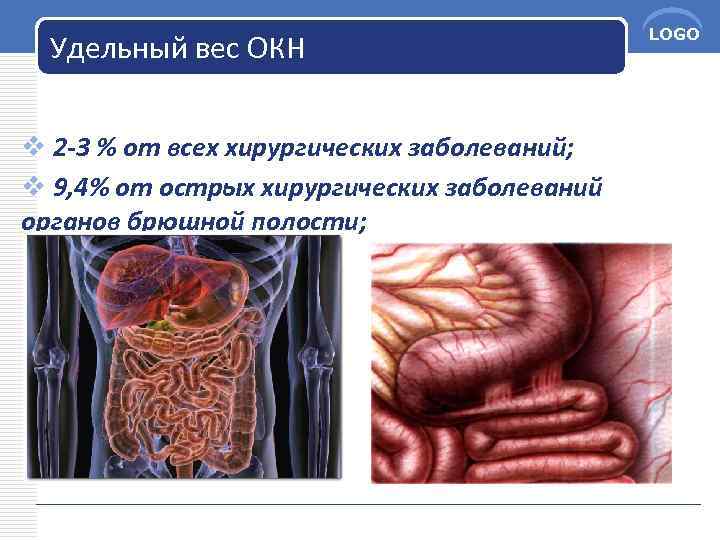 Удельный вес ОКН v 2 -3 % от всех хирургических заболеваний; v 9, 4%