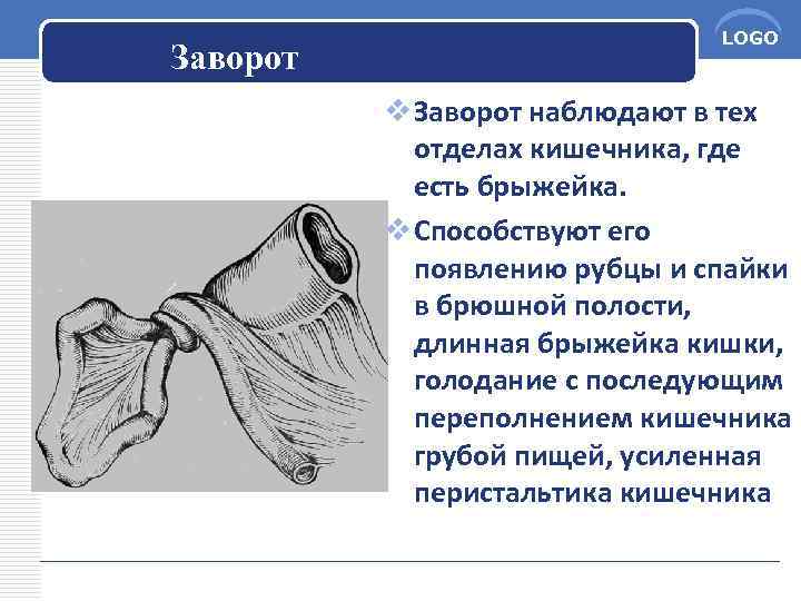 Заворот LOGO v Заворот наблюдают в тех отделах кишечника, где есть брыжейка. v Способствуют