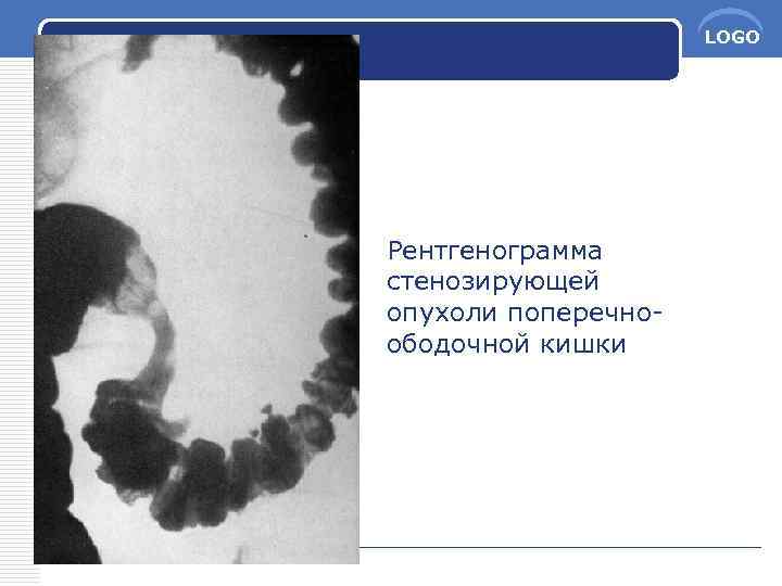 LOGO Рентгенограмма стенозирующей опухоли поперечноободочной кишки 