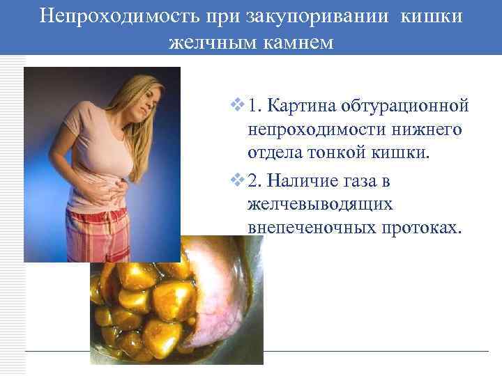 Непроходимость при закупоривании кишки LOGO желчным камнем v 1. Картина обтурационной непроходимости нижнего отдела