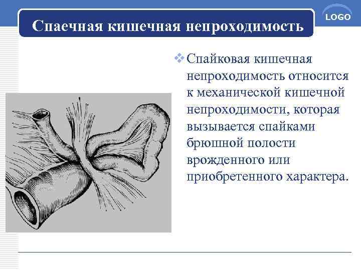 Спайки кишечника причины и симптомы лечение. Спаечная кишечная непроходимость классификация. Непроходимость кишечника спайка.