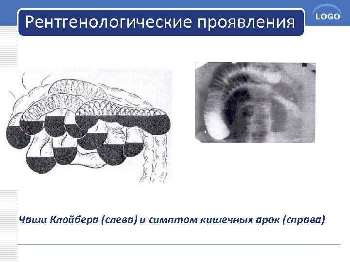 Рентгенологические проявления LOGO Чаши Клойбера (слева) и симптом кишечных арок (справа) 