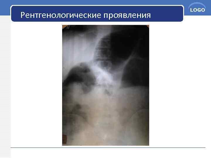 Рентгенологические проявления LOGO 