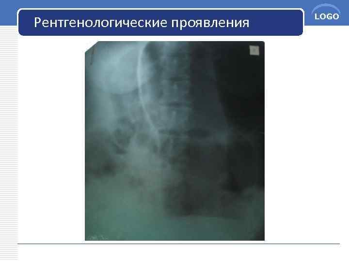 Рентгенологические проявления LOGO 