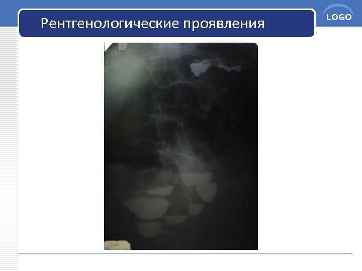 Рентгенологические проявления LOGO 