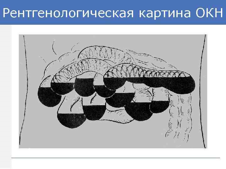 Рентгенологическая картина ОКН LOGO 