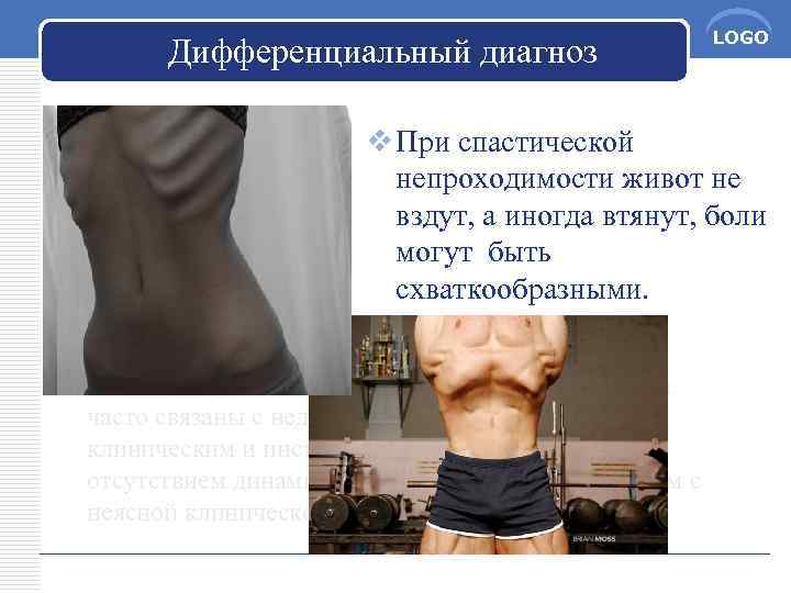 Дифференциальный диагноз LOGO v При спастической непроходимости живот не вздут, а иногда втянут, боли