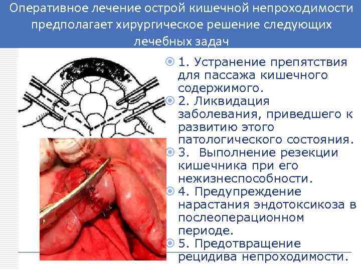 Оперативное лечение острой кишечной непроходимости LOGO предполагает хирургическое решение следующих лечебных задач 1. Устранение